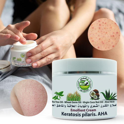 Keratosis Pilaris Cream Keratosis Pilaris Cream